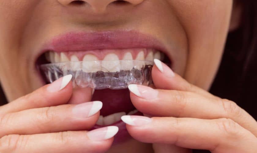 Can Invisalign Fix an Overbite?