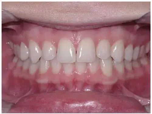 Frontal intraoral view showing upper and lower teeth alignment and dental occlusion.