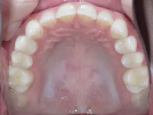 Occlusal view of upper teeth showing natural tooth alignment and dental health.