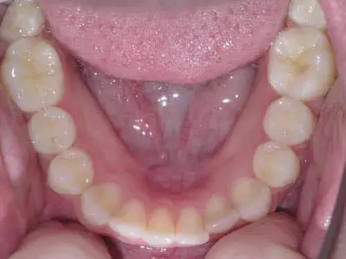 Occlusal view of mandibular teeth showing alignment and dental restoration work.